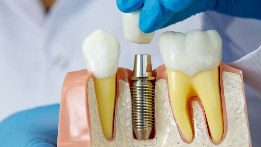 Implantes dentales Implantes dentales
